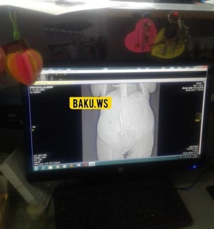 Azərbaycanda xəstəxanada dəhşət: Əməliyyatdan sonra xəstənin daxilində qayçı qaldı - FOTO