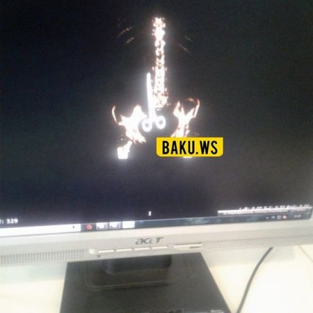 Azərbaycanda xəstəxanada dəhşət: Əməliyyatdan sonra xəstənin daxilində qayçı qaldı - FOTO