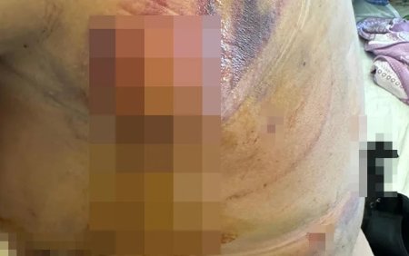 “Həkim məni 3 dəfə əməliyyat edib pis vəziyyətə qoydu” – Foto