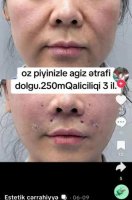 Dr.Ella necə estetik əməliyyatlar icra edir? -Araşdırma